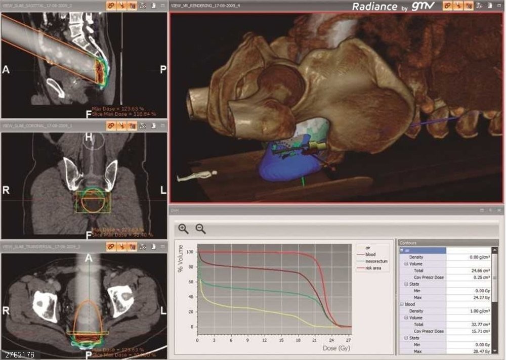 Experto destaca los beneficios de la radioterapia intraoperatoria en el cáncer de colon Pantalla-radiance-by-GMV (1)