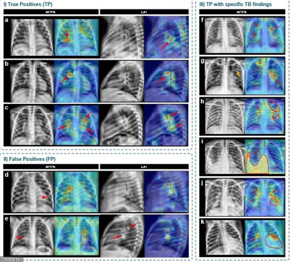 Un sistema basado en Inteligencia Artificial permite detectar radiografías compatibles con tuberculosis en niños Mapas de activación generados mediante técnicas de explicabilidad que señalan las regiones de interés utilizadas por el modelo para tomar sus decisiones sobre las radiografías
