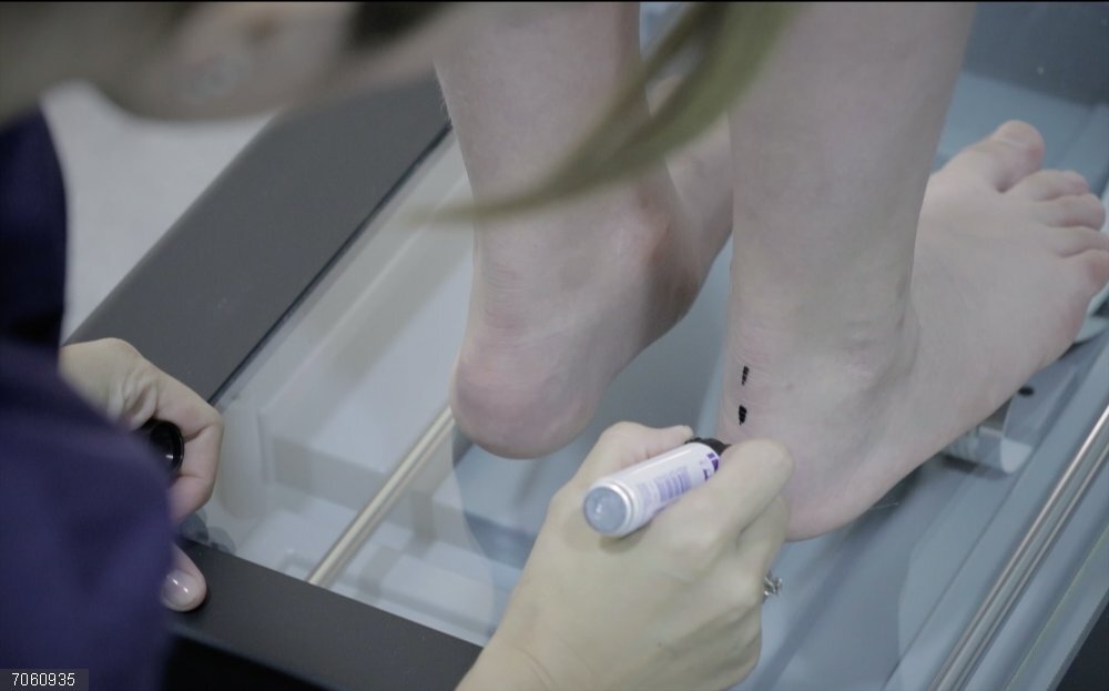 La obesidad infantil puede suponer hasta un 40% más de presión sobre el pie La obesidad infantil puede suponer hasta un 40% más de presión sobre el pie